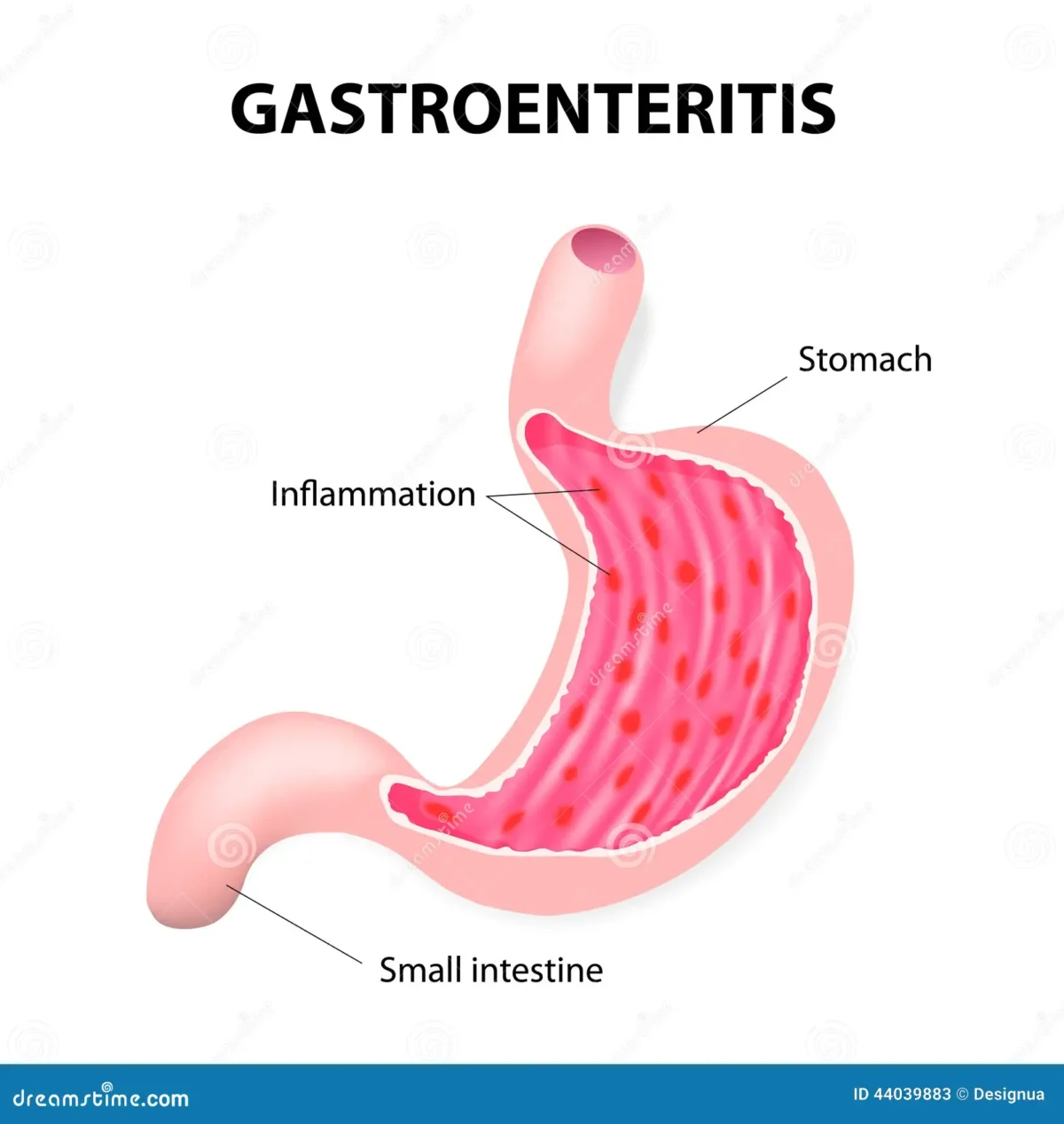 stomach-virus-gastroenteritis-flu-gastric-flu-44039883-1200x1268.webp